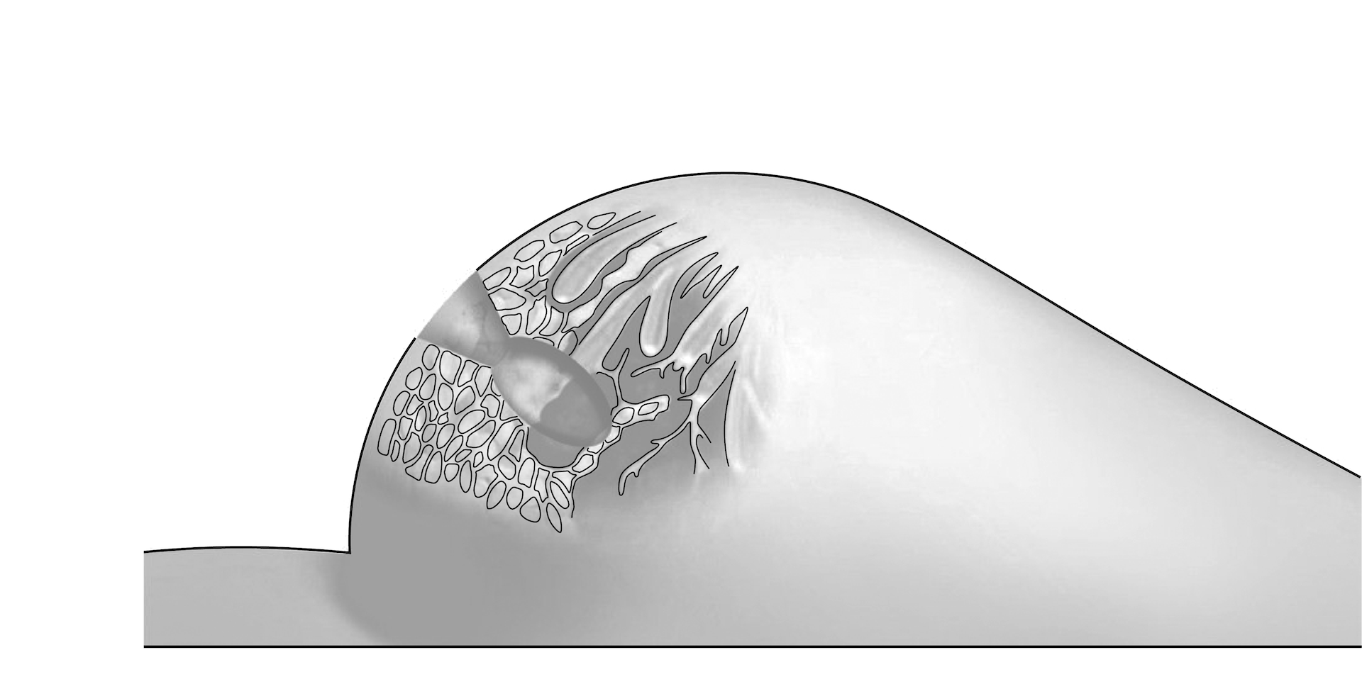 Der Tumor wird operativ entfernt.