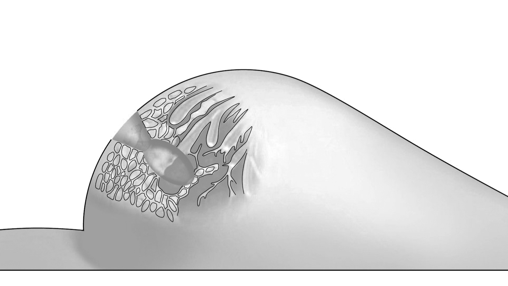 Der Tumor wird operativ entfernt.