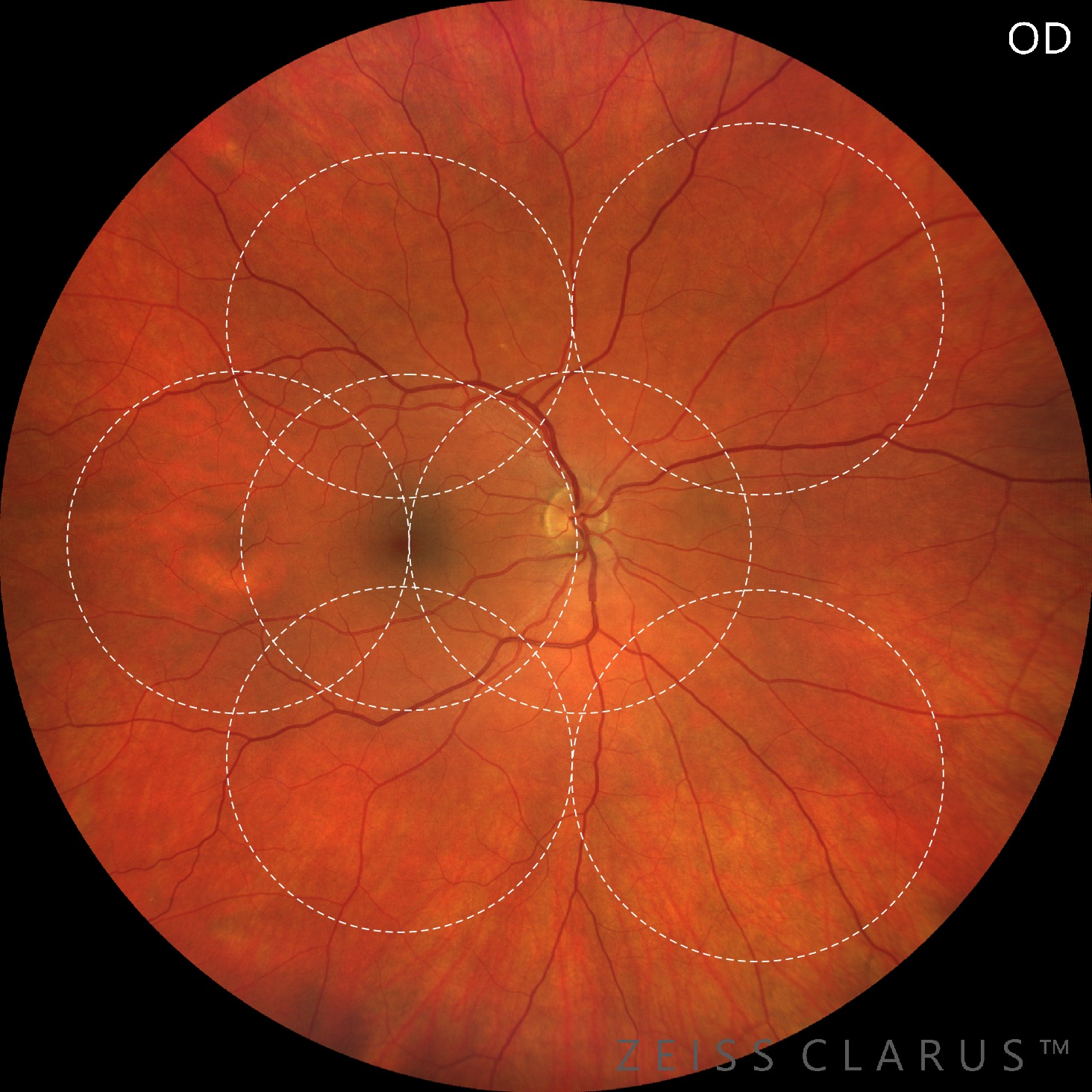 CLARUS ETDRS