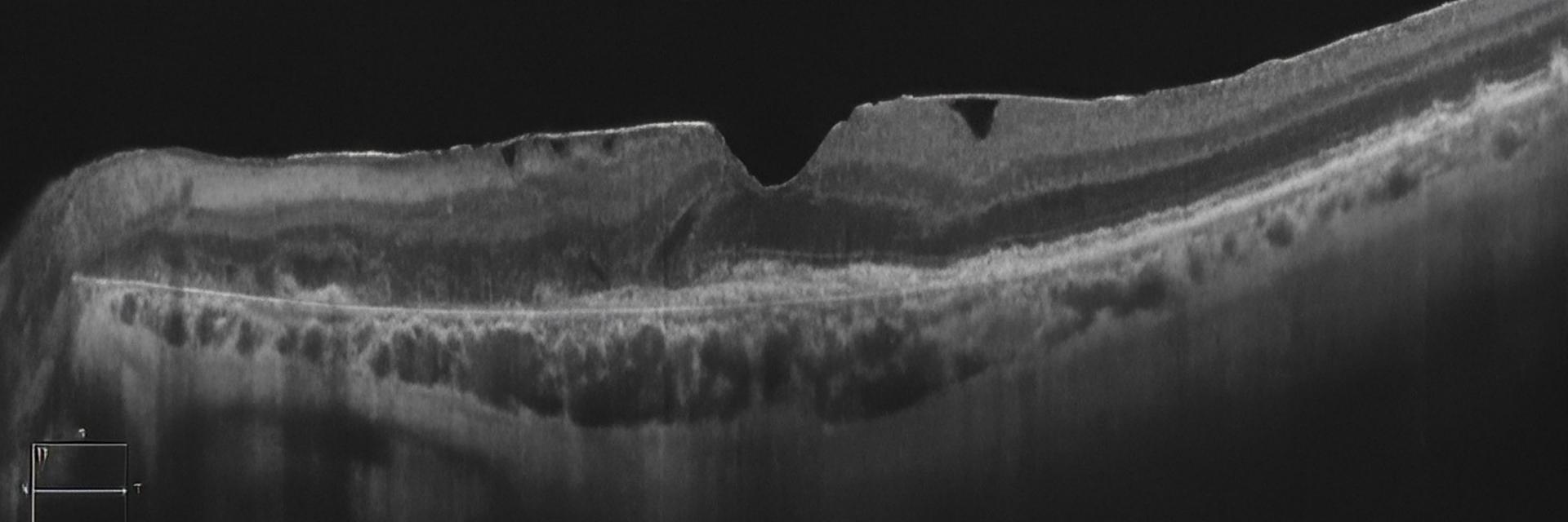 Altersbedingte Makuladegeneration (AMD) und der ZEISS Workflow