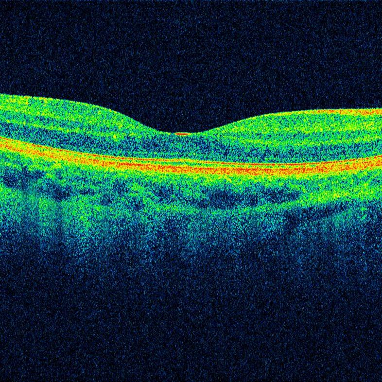 OCT Scan der Netzhaut