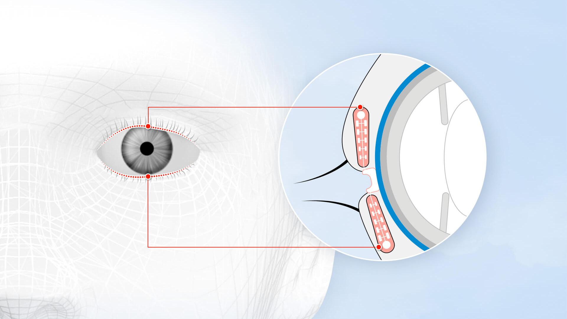 Jedes Auge hat etwa 70 Lidranddrüsen oder Meibomdrüsen, die über die Ober- und Unterlider verteilt sind.