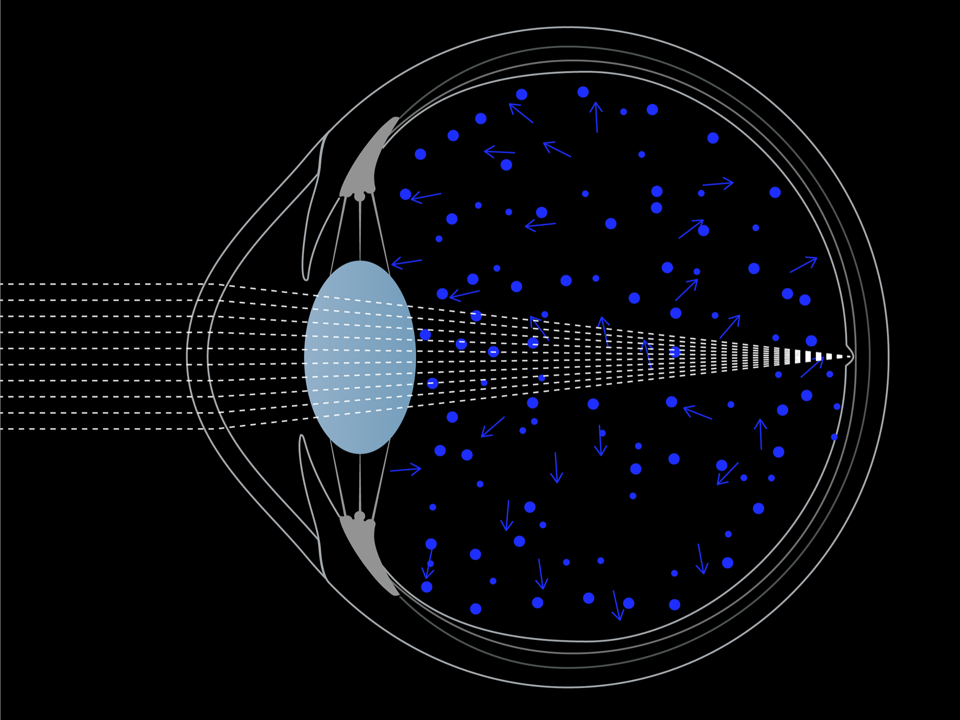 Abbildung von ins Auge eindringendem Licht, die zeigt, dass die Streuung im Auge bei blauem Licht stärker ist, als bei weißem Licht. 