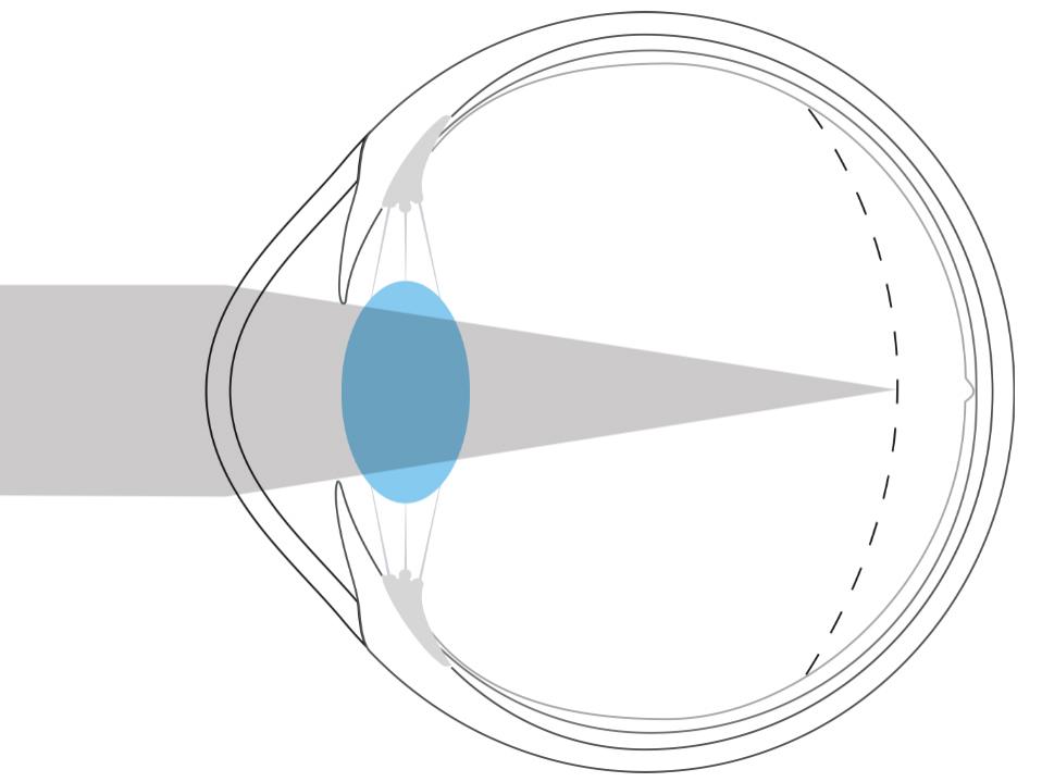 Abbildung eines kurzsichtigen Auges, das zeigt, dass Licht vor der Netzhaut gebrochen wird.