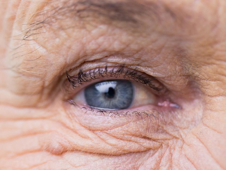 Eine Abbildung zeigt Photoaging im Bereich der Augen.