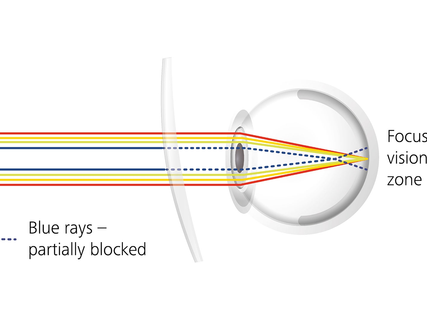 Veranschaulichung, wie Brillenglasbeschichtungen die Blendung reduzieren können, indem sie Anteile blauen Lichtes blocken 